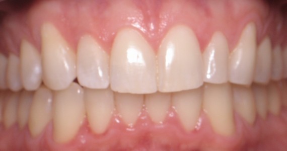 After Invisalign and Cosmetic Contouring